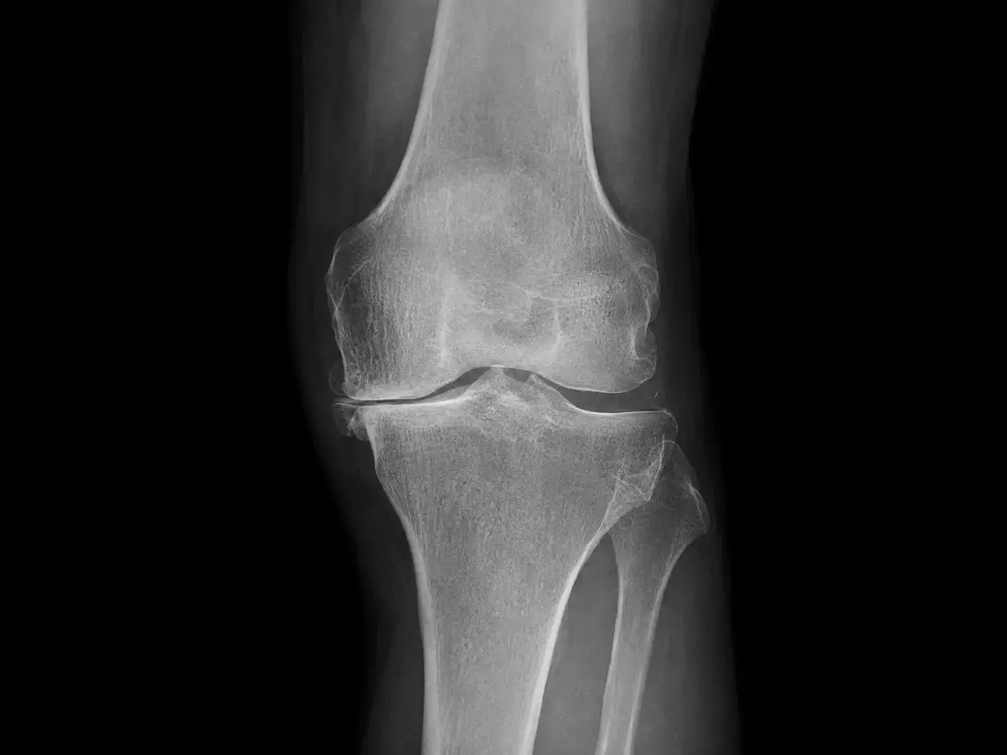 Radiografía de rodilla con desgaste