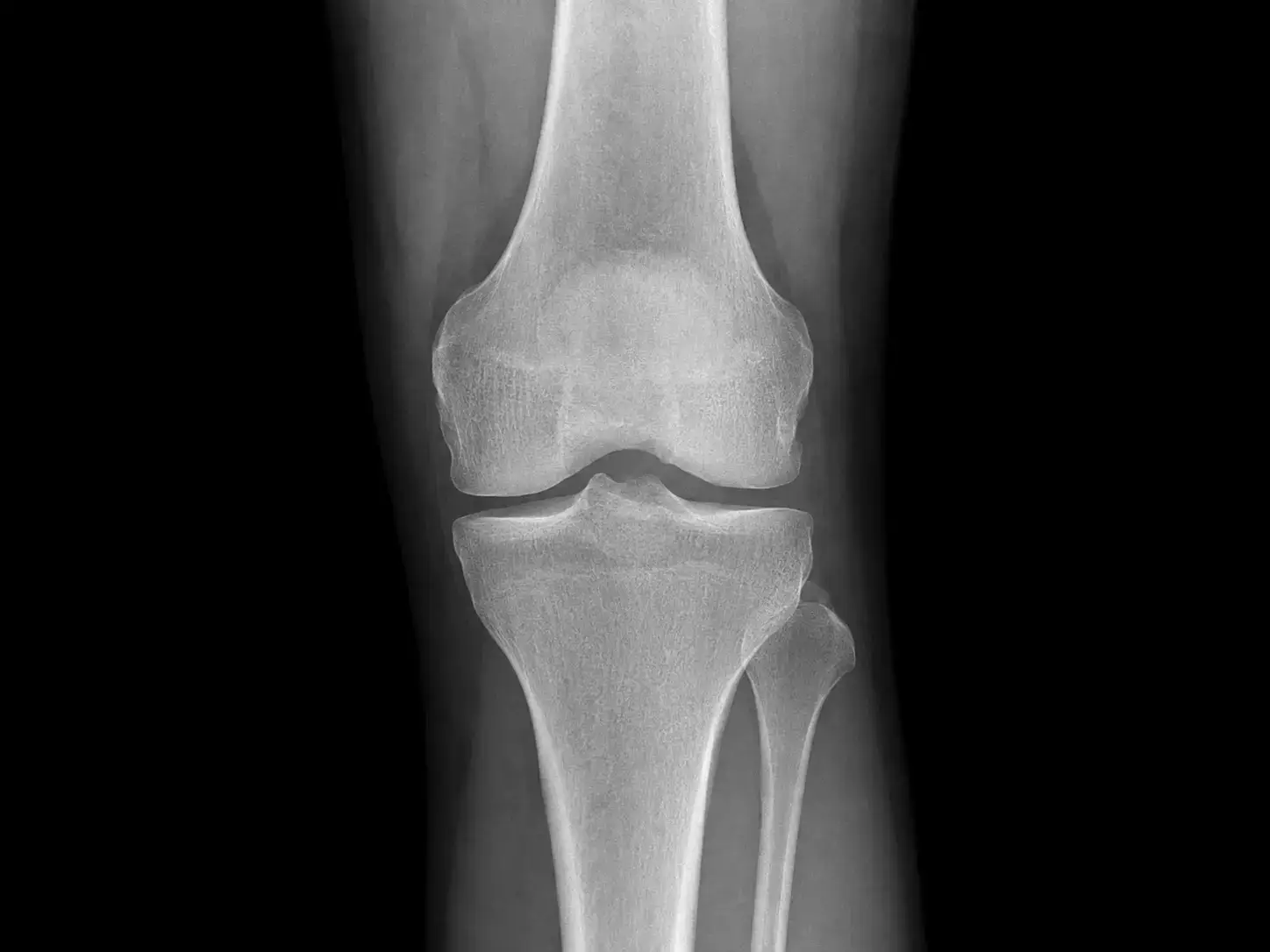 Radiografía de rodilla sana